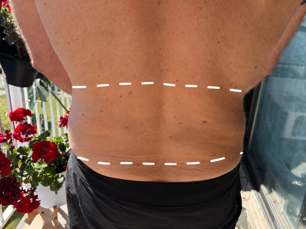 Acupuncture for low back pain. What is it low back pain?