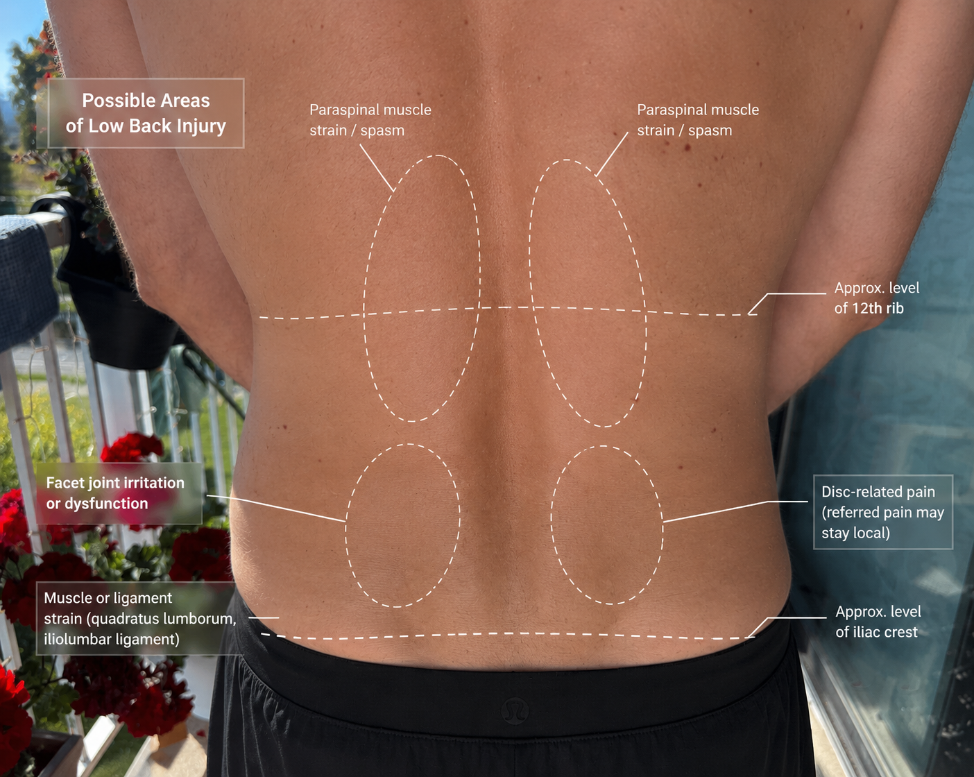 Acupuncture for low back pain at Victoria Healing Space