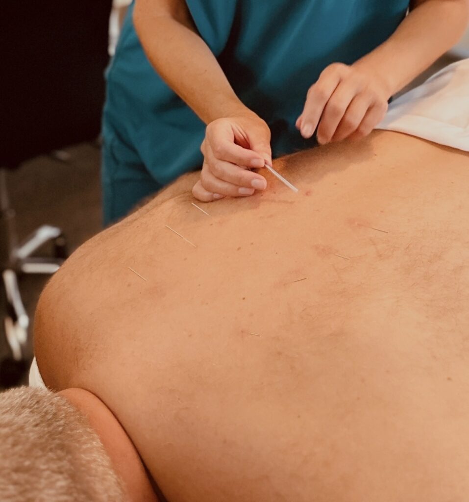 Acupuncture for low back pain at Victoria Healing Space.