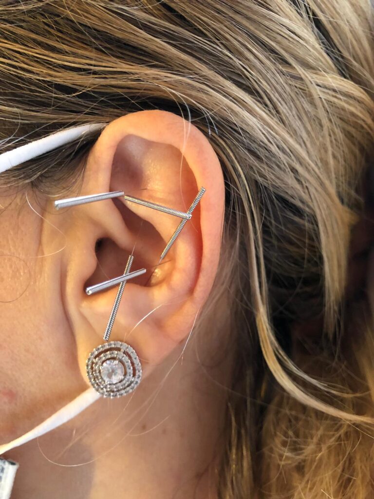 Auricular Acupuncture in Victoria BC