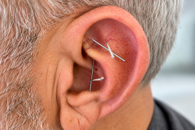 Ear acupuncture treatment with fine needles at Victoria Healing Space in Victoria, BC