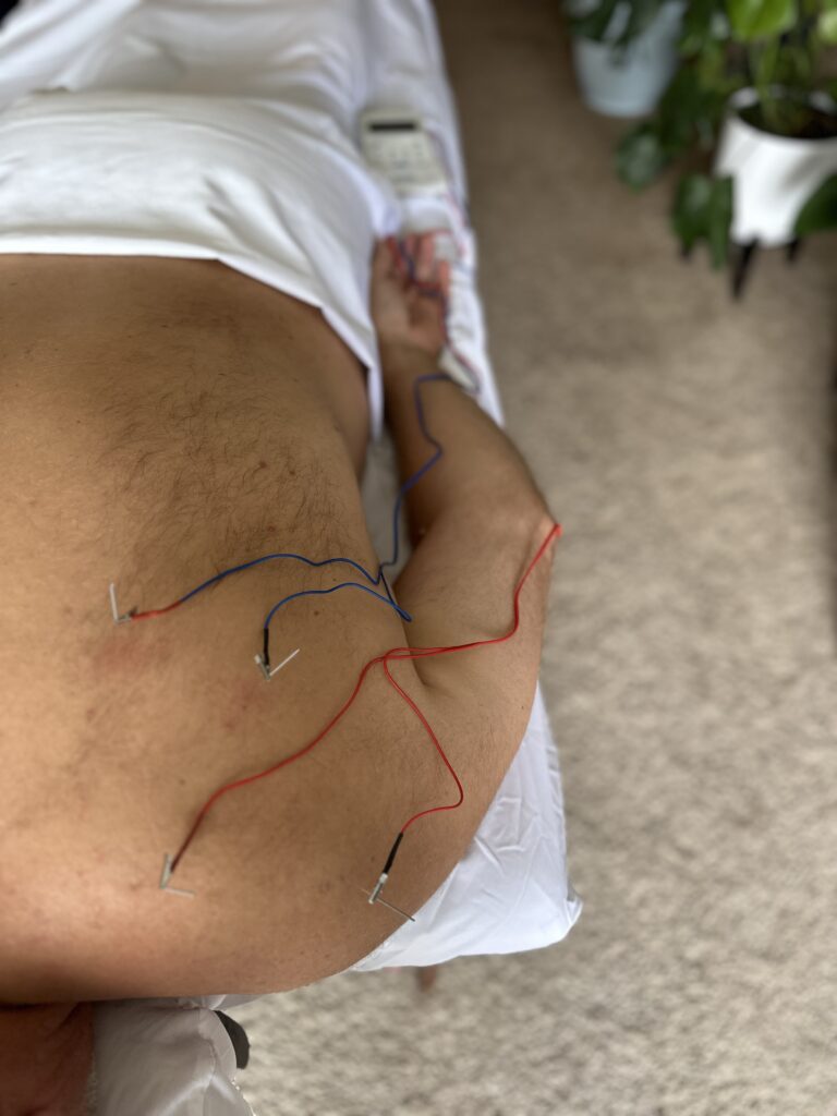 Electroacupuncture in Victoria BC vs TENS.