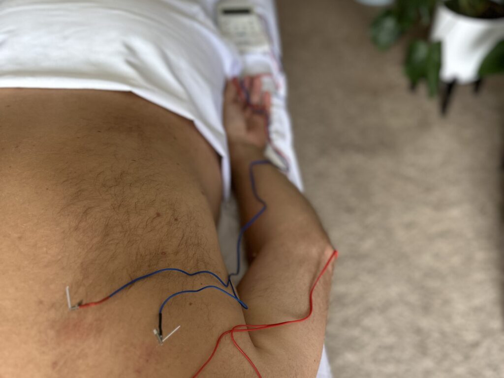 Treatment methods at Victoria Healing Space. Electroacupuncture