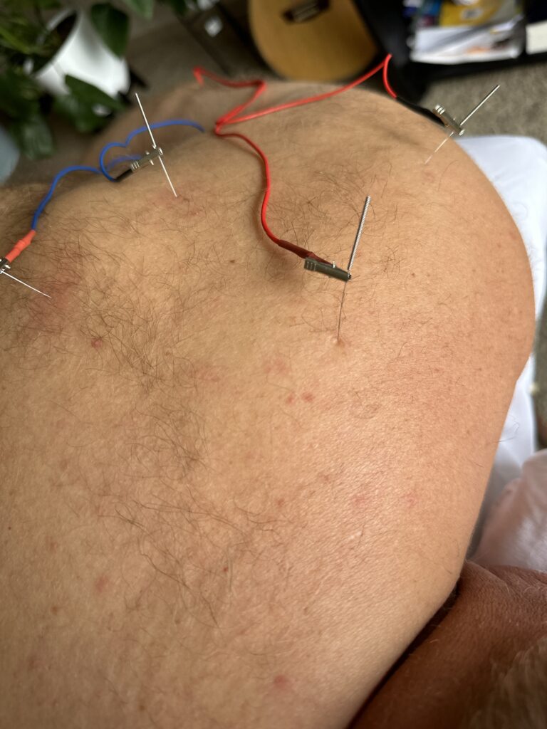 Electroacupuncture: who may benefit. Victoria Healing Space.