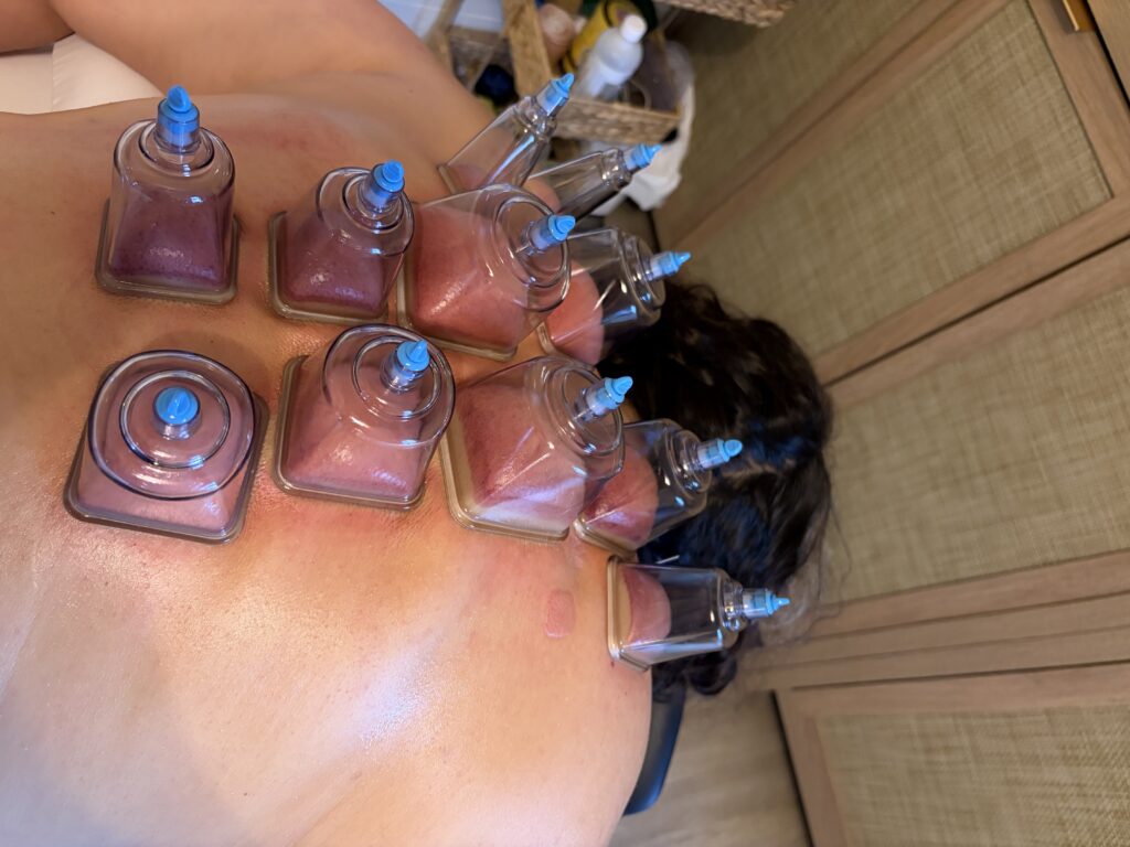 Treatment methods at Victoria Healing Space with Cupping. Cupping Victoria BC.