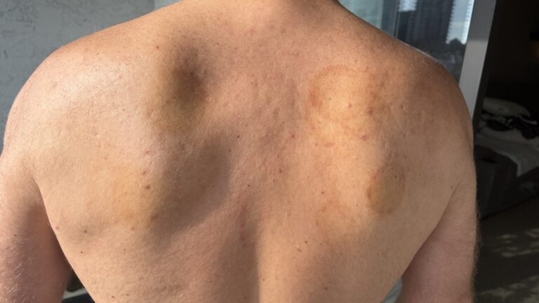 Cupping marks: what do they mean?