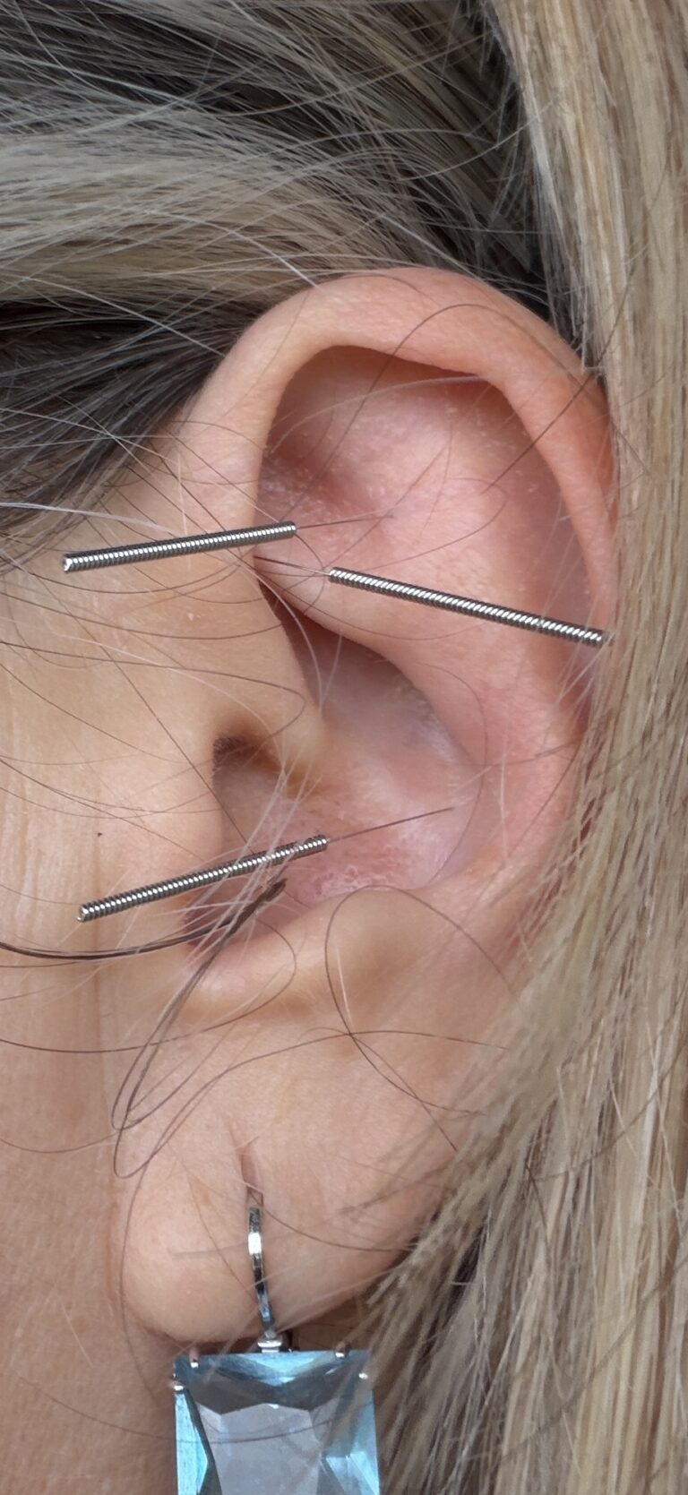 Ear Acupuncture Victoria NADA protocol